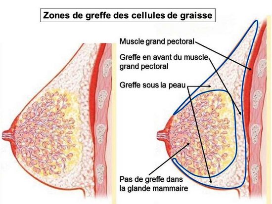 prix lipofilling mammaire tunisie - injection graisse seins