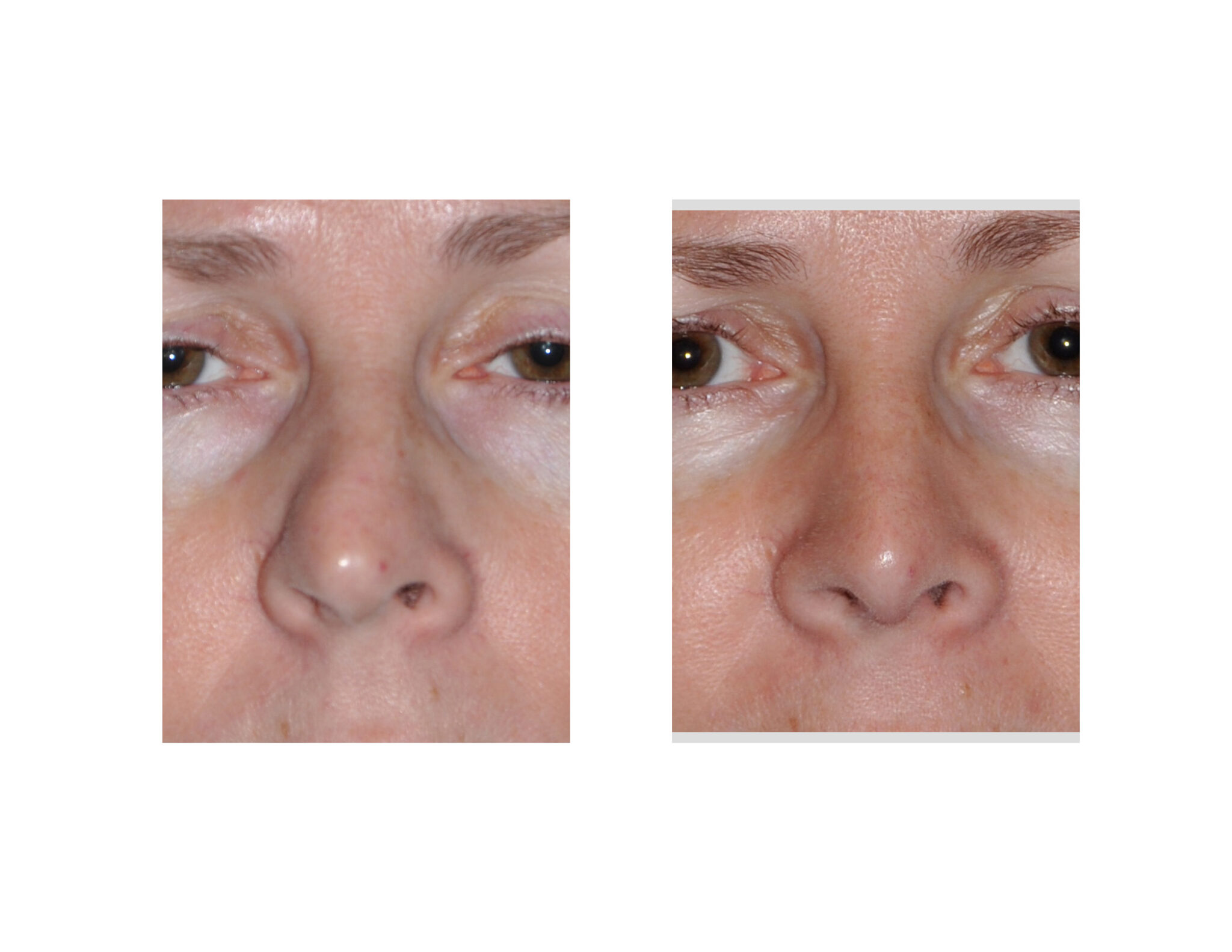 Spreader grafts La rhinoplastie par greffe d'écartement