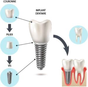 implantologie dentaire questions
