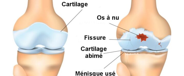 traitement arthrose genoux