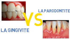 Différence entre la gingivite et la parodontite