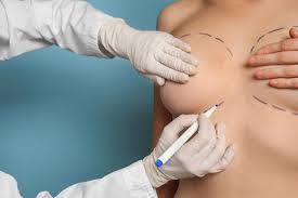 Chirurgie esthetique seins Lyon